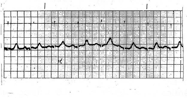 Figura 2 - Um eletrocardiograma
